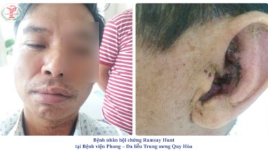 Bệnh nhân hội chứng Ramsay Hunt tại Bệnh viện Phong - Da liễu Trung ương Quy Hoà