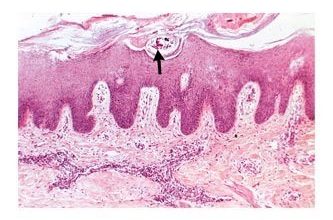 Vị trí ký sinh và gây bệnh ở vùng da niêm do Sarcoptes scarbiei