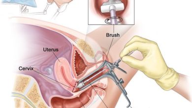 Quy trình thực hiện phết tế bào cổ tử cung