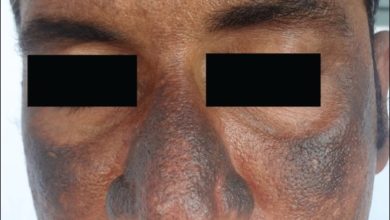 OCHRONOSIS Ngoại sinh