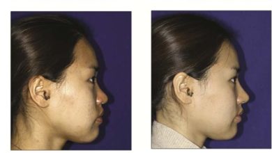 Hình 5. (A) Phụ nữ 23 tuổi, đầu mũi tròn to, 1 năm sau khi dùng SEG ghép tăng cường vách ngăn qua phương pháp lai căng. (B) Bóc tách rộng tạo điều kiện tiếp xúc và khâu mảnh ghép, nhưng vẫn cho phép kiểm soát tinh tế hình dạng mũi với da nguyên vẹn.