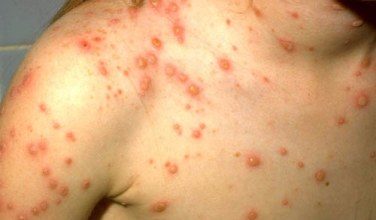 Hình ảnh thủy đậu ở người chưa tiêm phòng