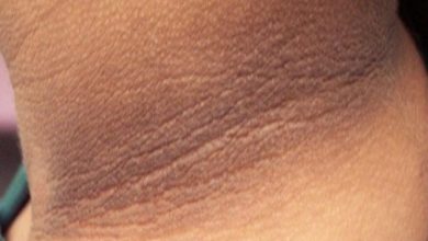 HÌNH ẢNH BỆNH GAI ĐEN